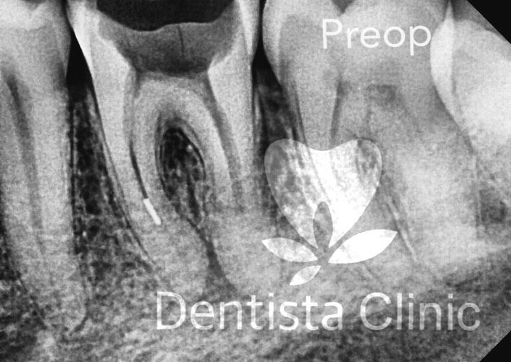 two root mandibular canine