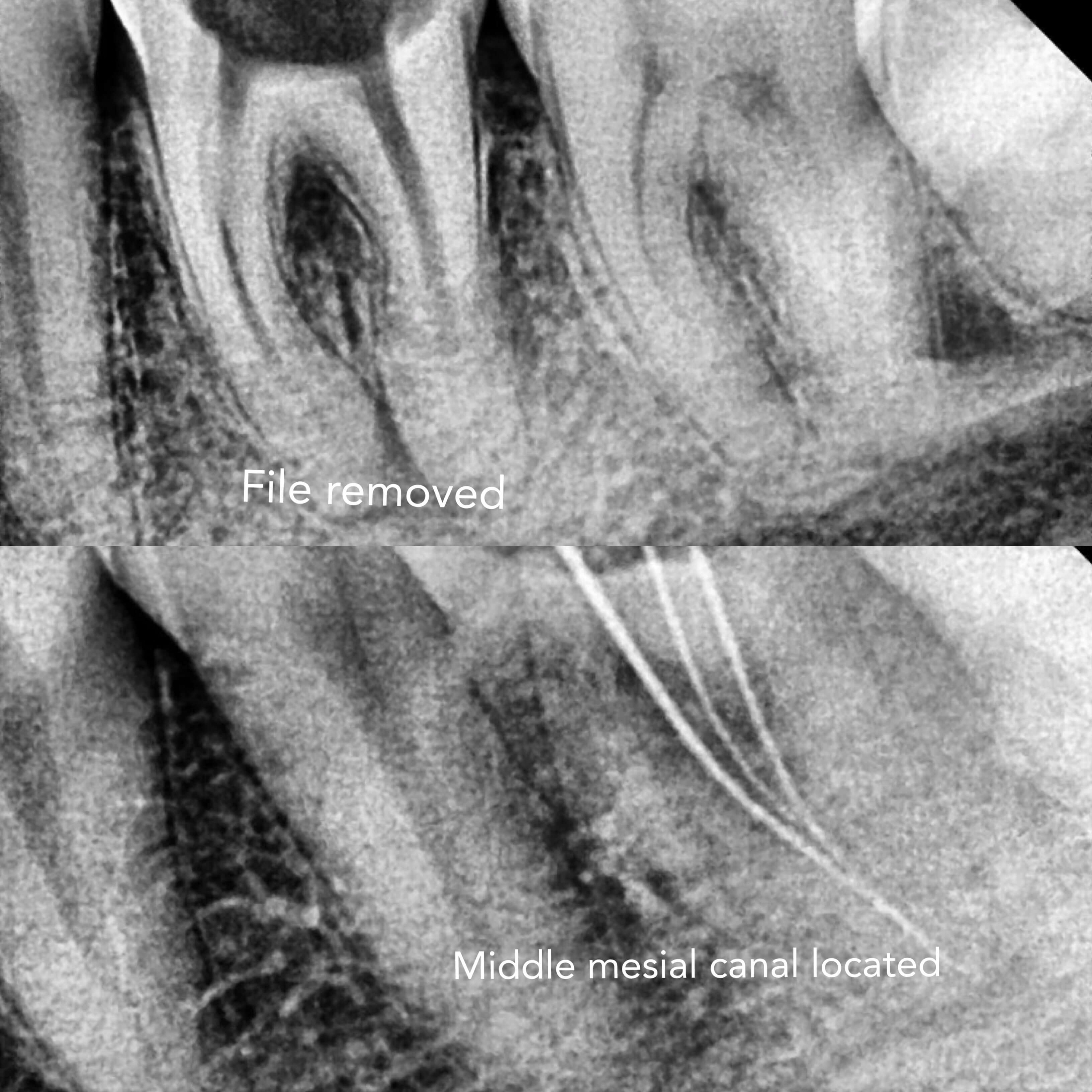 two root mandibular canine