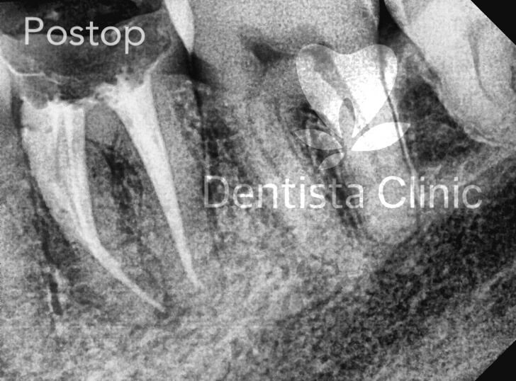 two root mandibular canine