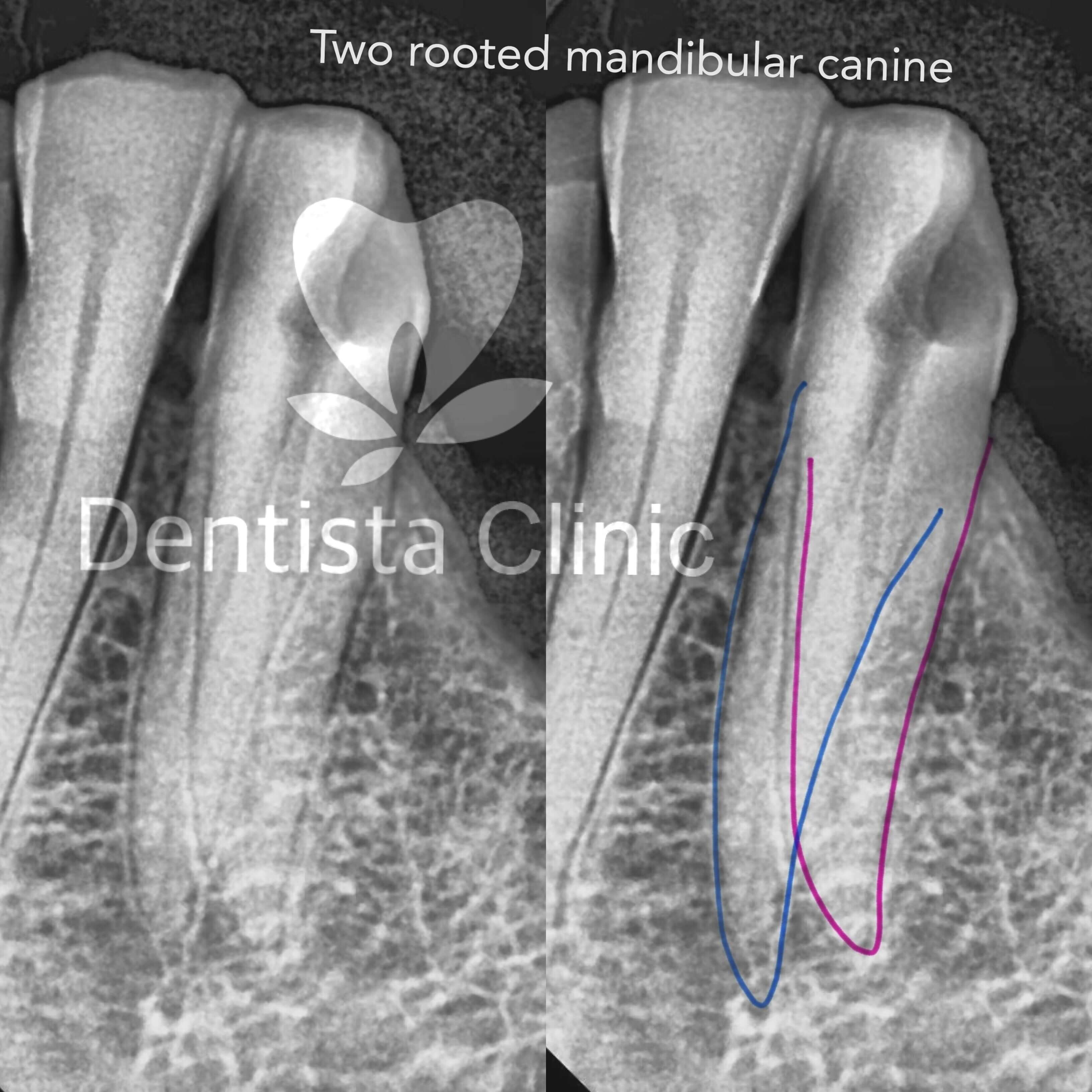 two root mandibular canine