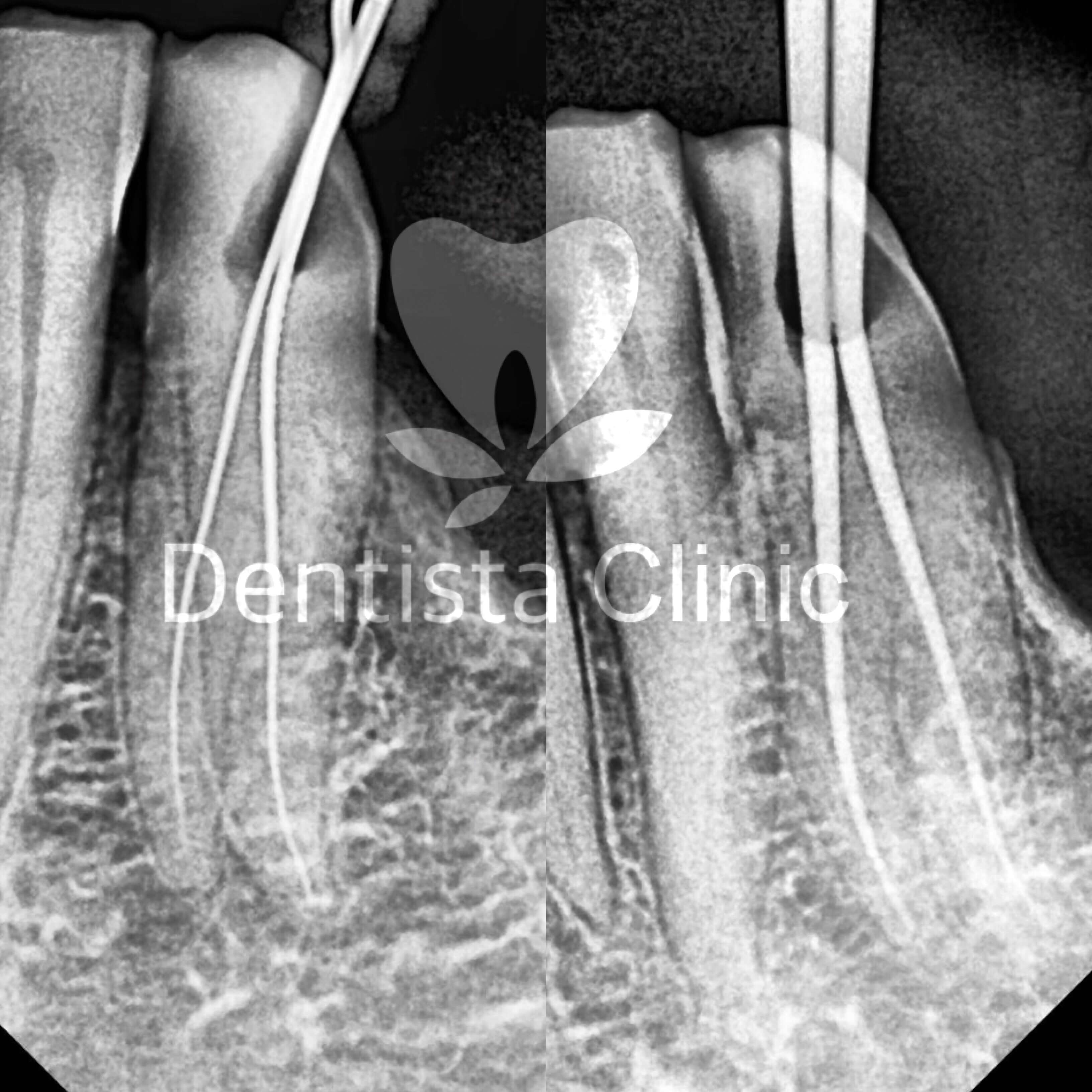 two root mandibular canine