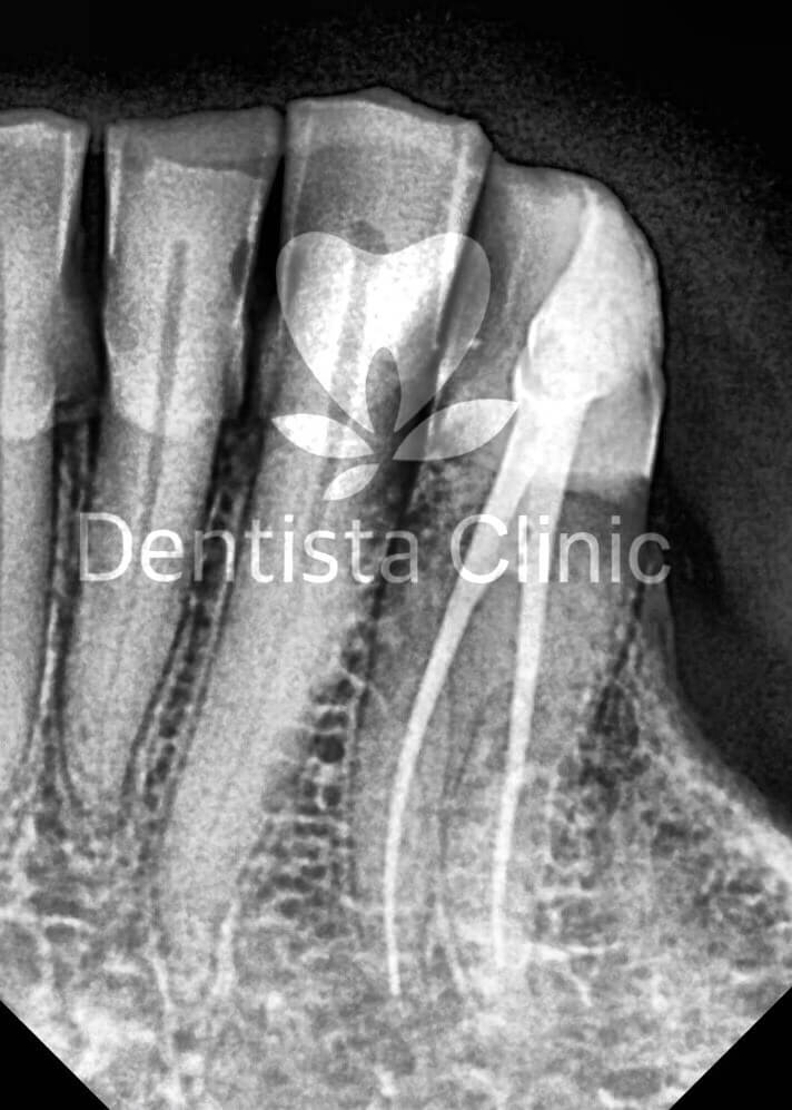 two root mandibular canine