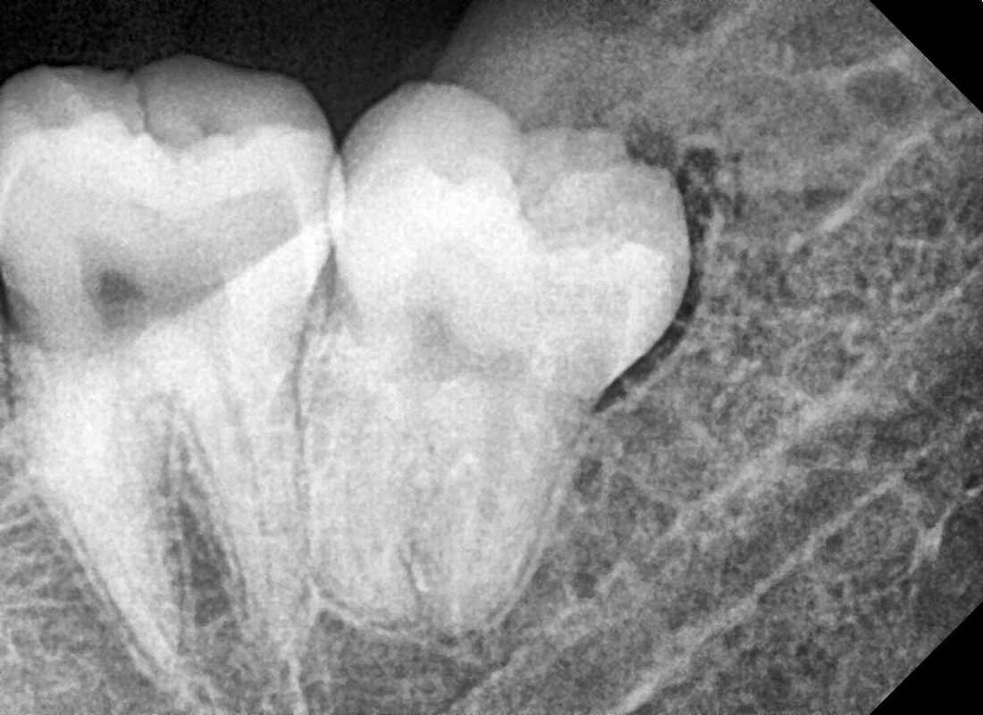 Wisdom tooth