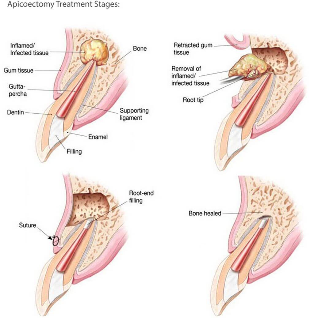 Apisectomy