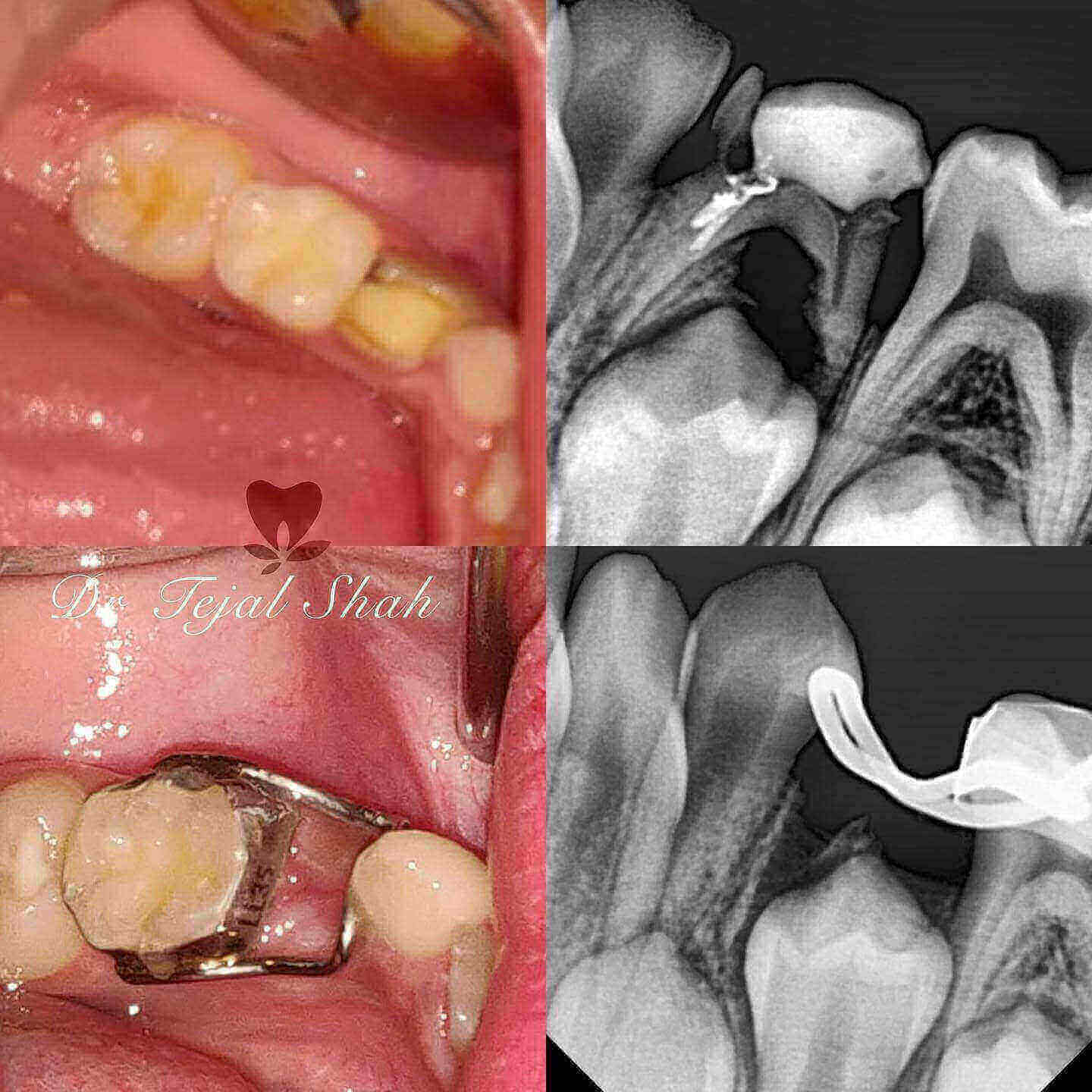 brackets for teath