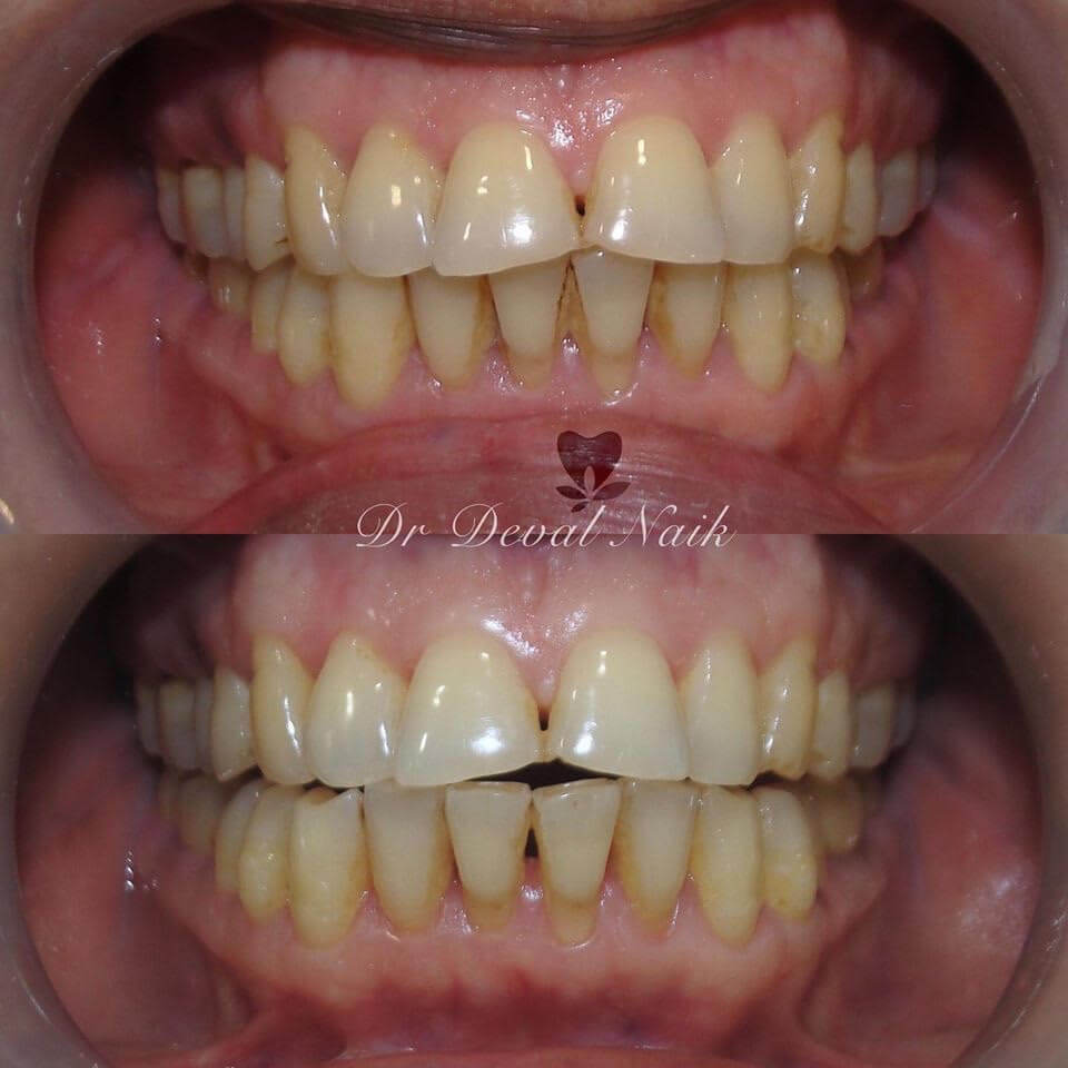before after images of tooth cleaning